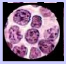 Lymphoblastic Lymphoma T Cells