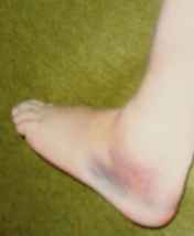 Fractured foot 2