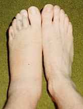 Fractured foot 1