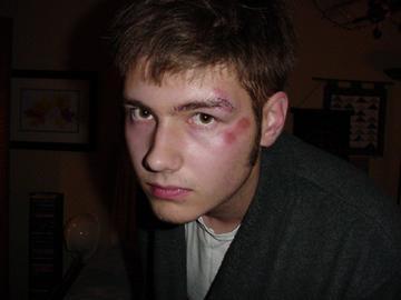 Got in a fight with a trash can and lost. 