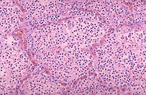 bronchopneumonia histology