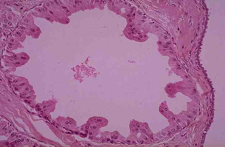 fibrocystic breast changes upper fibrocystic breast changes upper