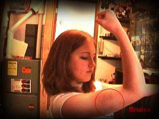 Bruise
