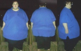 Amanda at 4 months after surgery