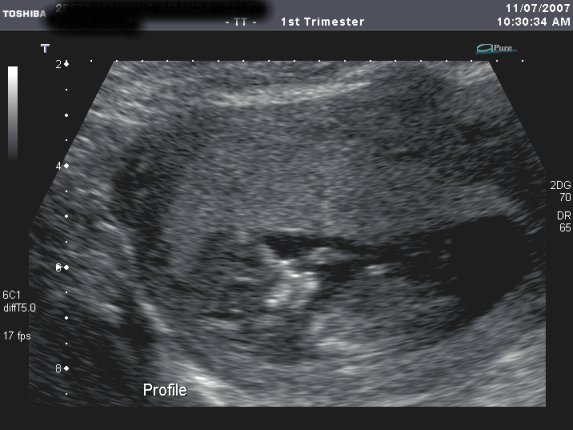 Amanda's 12 week ultrasound, 11th July 2007