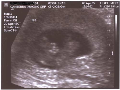 Our little peanut! 