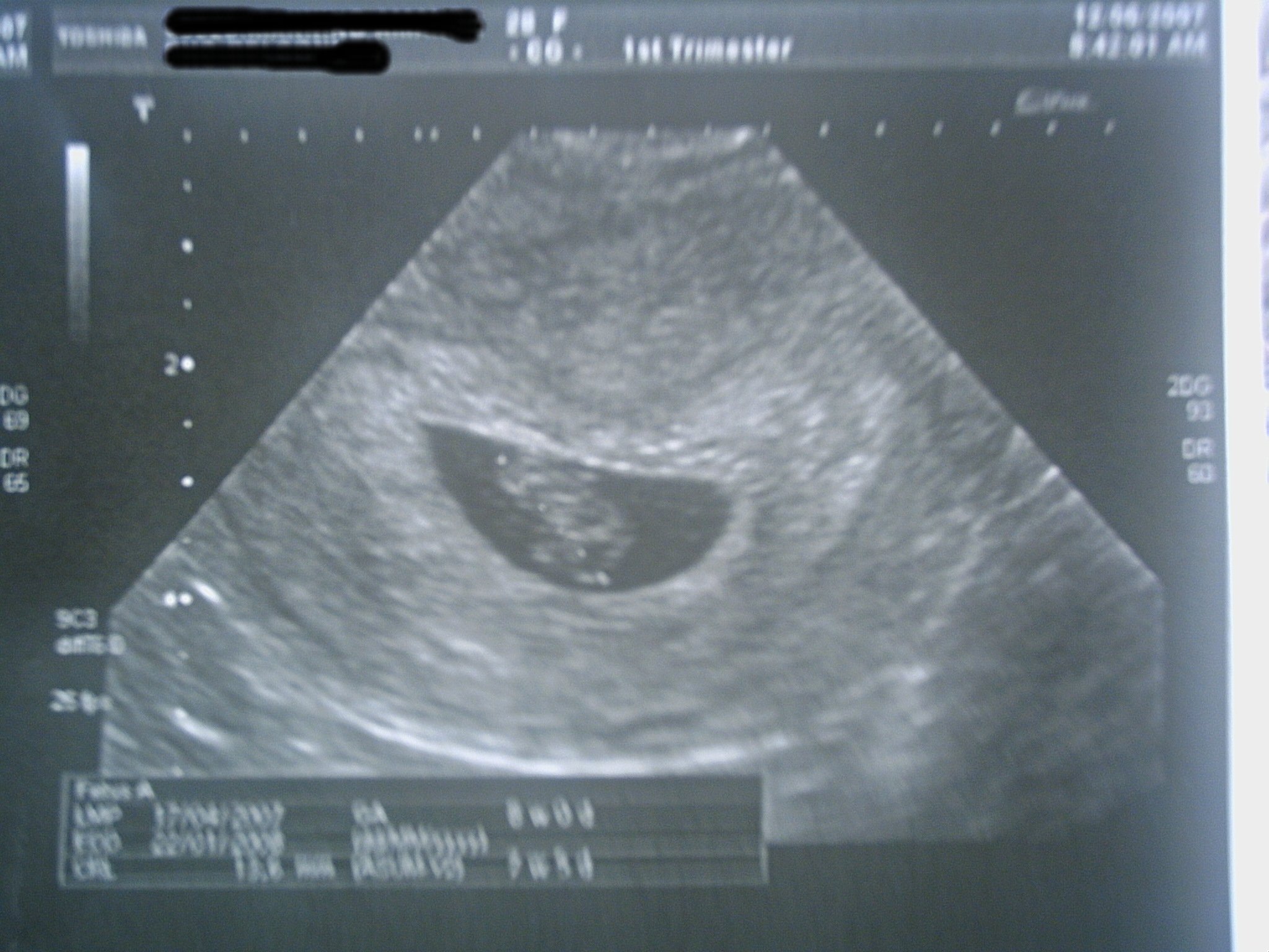 Peanut ultrasound - 12th June 2007 @ 8 weeks