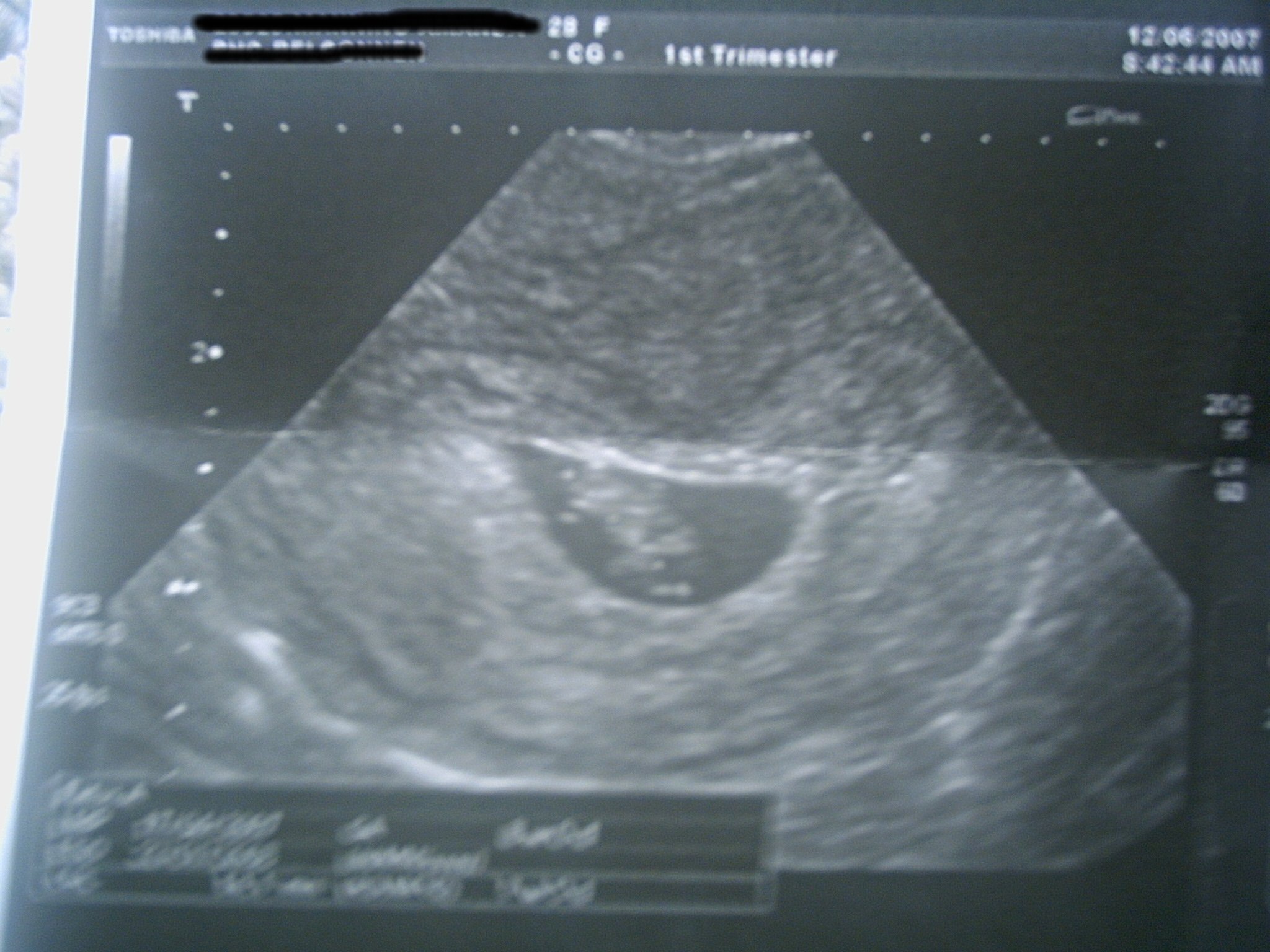 Peanut 2 ultrasound taken on 12th June 2007 @ 8 weeks