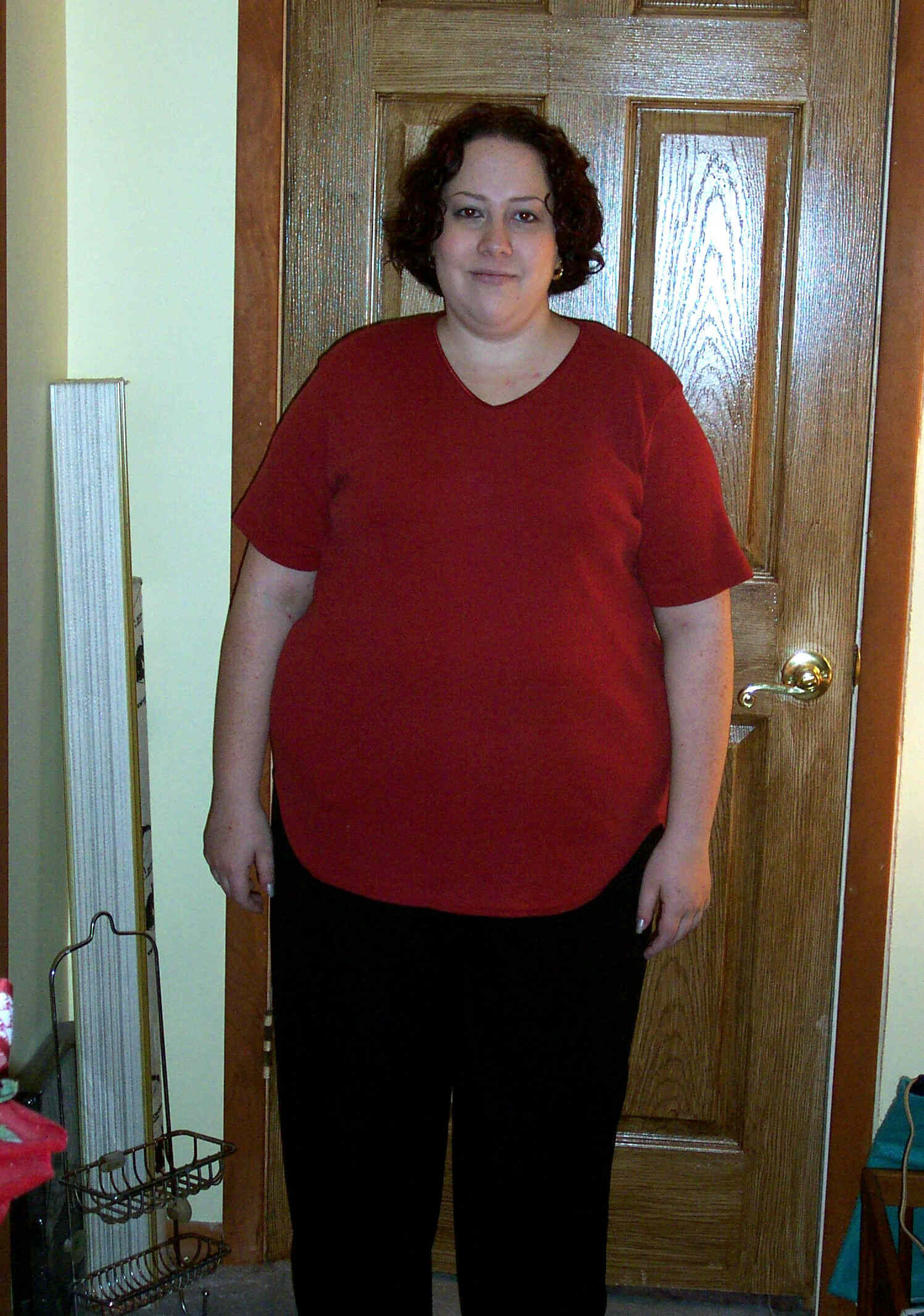 Me-A few days before surgery(240lbs)