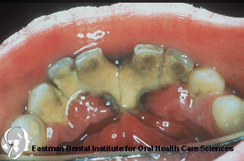 c�lculo acumulado na lingual dos dentes