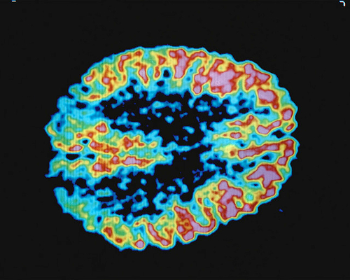 Brainscan image