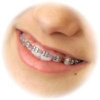 Dental Braces