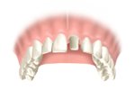 Dental Crowns