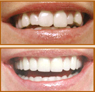 Veneers