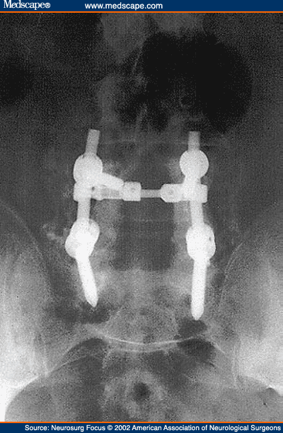 4 screws with 2 rods threaded through.