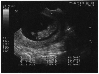 Click on image to return to sonogram pictures