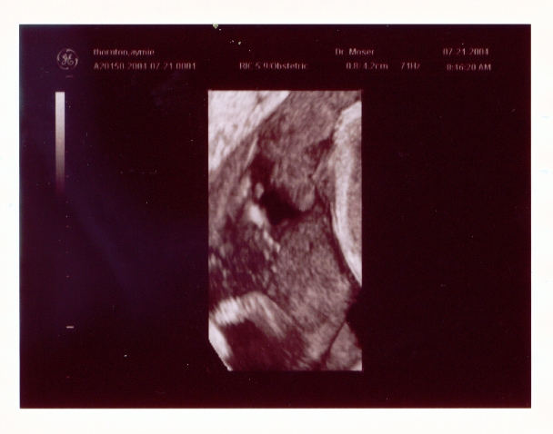 Click on picture to return to sonogram pictures