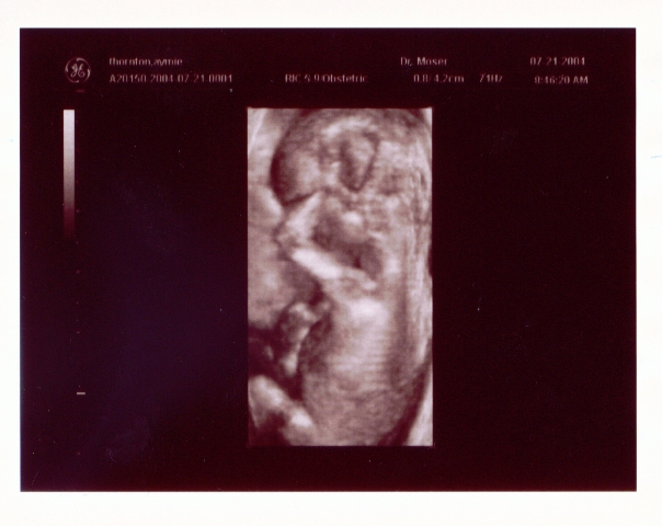 Click on picture to return to sonogram pictures