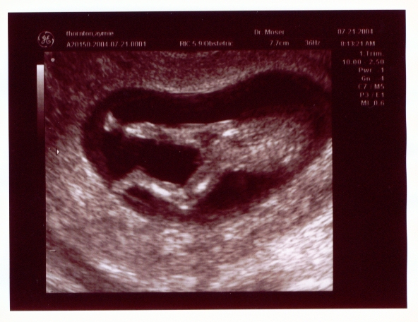 Click here to see the rest of the sonogram pictures