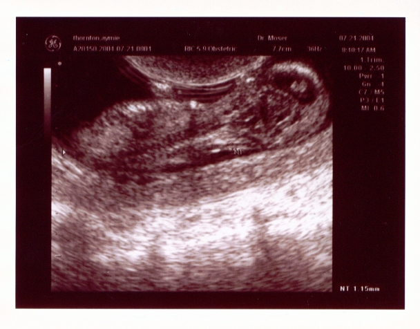Click on picture to return to sonogram pictures