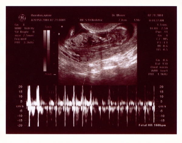 Click on picture to return to sonogram pictures