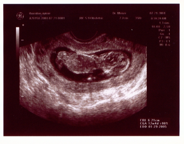 Click on picture to return to sonogram pictures