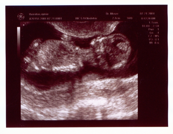 Click on picture to return to sonogram pictures