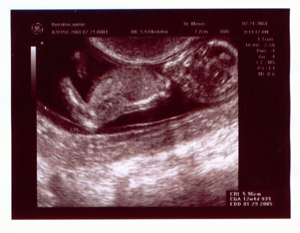 Click on picture to return to sonogram pictures