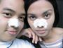 blackheads beware