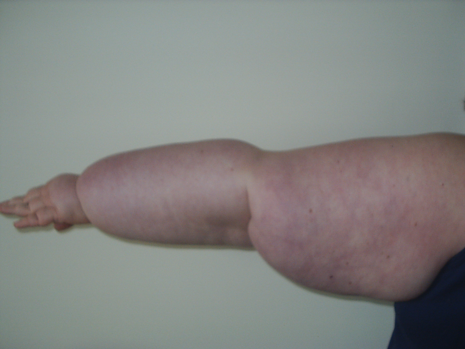 Lymphoedema badly affects my mother's left arm and hand, causing swelling, discomfort, restricted movement and usage, and potentially leading to severe infections.