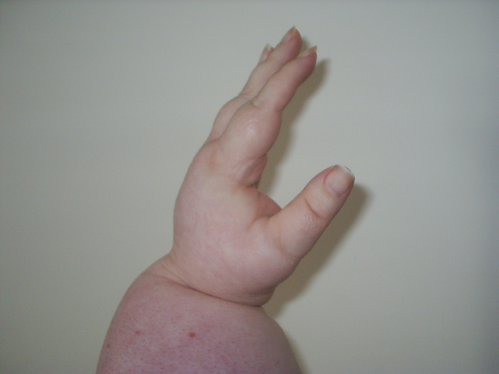Lymphoedema badly affects my mother's left arm and hand, causing swelling, discomfort, restricted movement and usage, and potentially leading to severe infections.