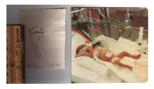This is me at ten days old in ICU.