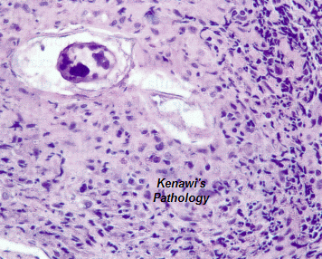 Bilharzia Ova In Rectal Submucosa