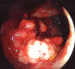 Cauliflower Carcinoma Of The Rectum