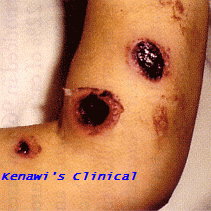 Ecthyma Gangrenosum