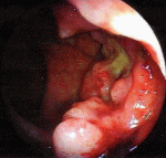 Malignant Transformation In Rectal Polyp