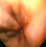 OesophagealVarix
