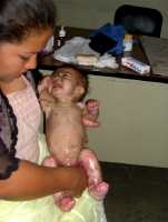 a very malnourished little girl, at 12 months of age and just 12 lbs.