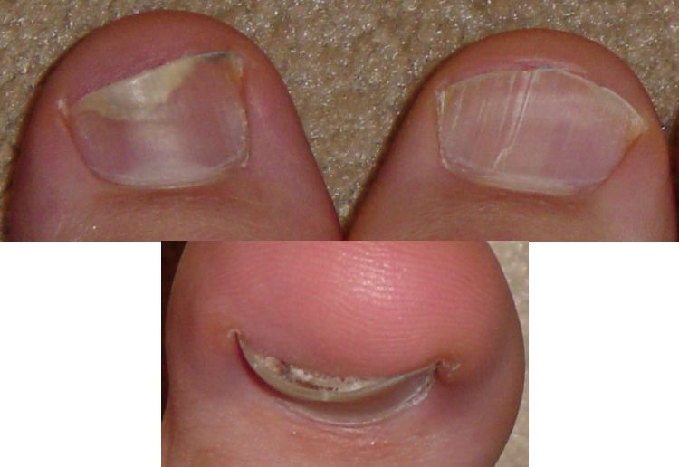 ugly toe collage