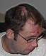 The Scar on my head and face