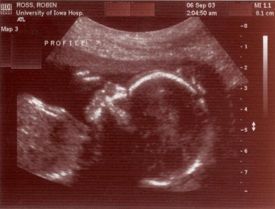 This is the ultrasound of Liam's profile.