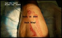 Only 4 Stiches for the Deep Gash - woohoo!