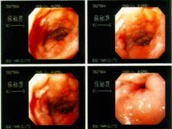Endoscopic images of a duodenal ulcer.