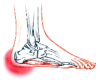 Bunions