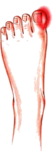 Bunions