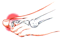 Bunions