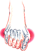 Bunions