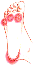 Bunions