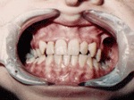 Patient photo after treatment