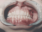 Patient photo after treatment